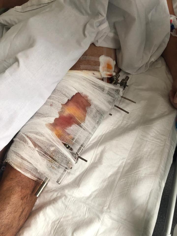 Фото: Facebook Арахамія "Стріляли з Калашникова". Арахамія показав кулю з ноги пораненого водія Шефіра: фото
