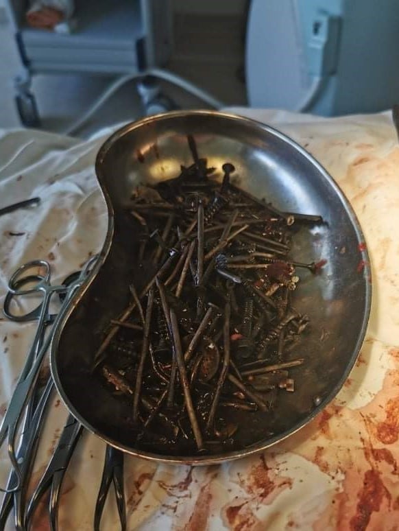 Изъятые предметы из желудка (Фото – пресс-служба больницы) В Литве врачи удалили из желудка мужчины более килограмма гвоздей, шурупов и гаек – фото