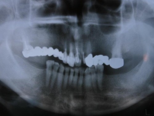 На нижній щелепі не заміщені дефекти зубних рядів, на верхній щелепі – перевантаження опорних зубів нераціональним мостоподібним протезом