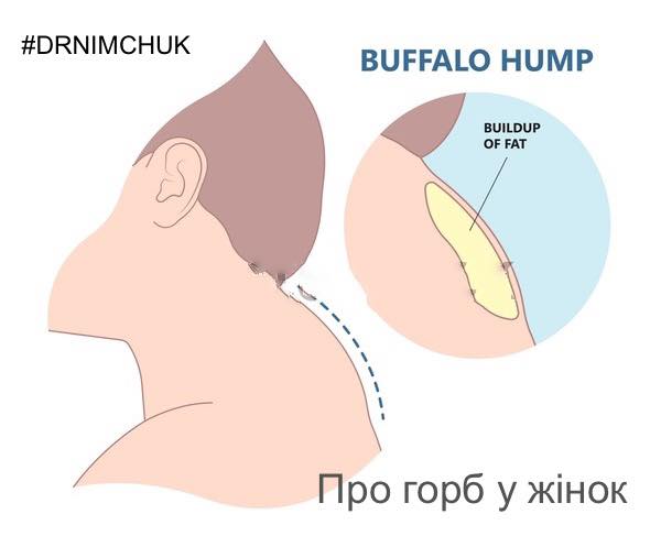 Горб у женщин. Иллюстрация со страницы Анатолия Нимчука