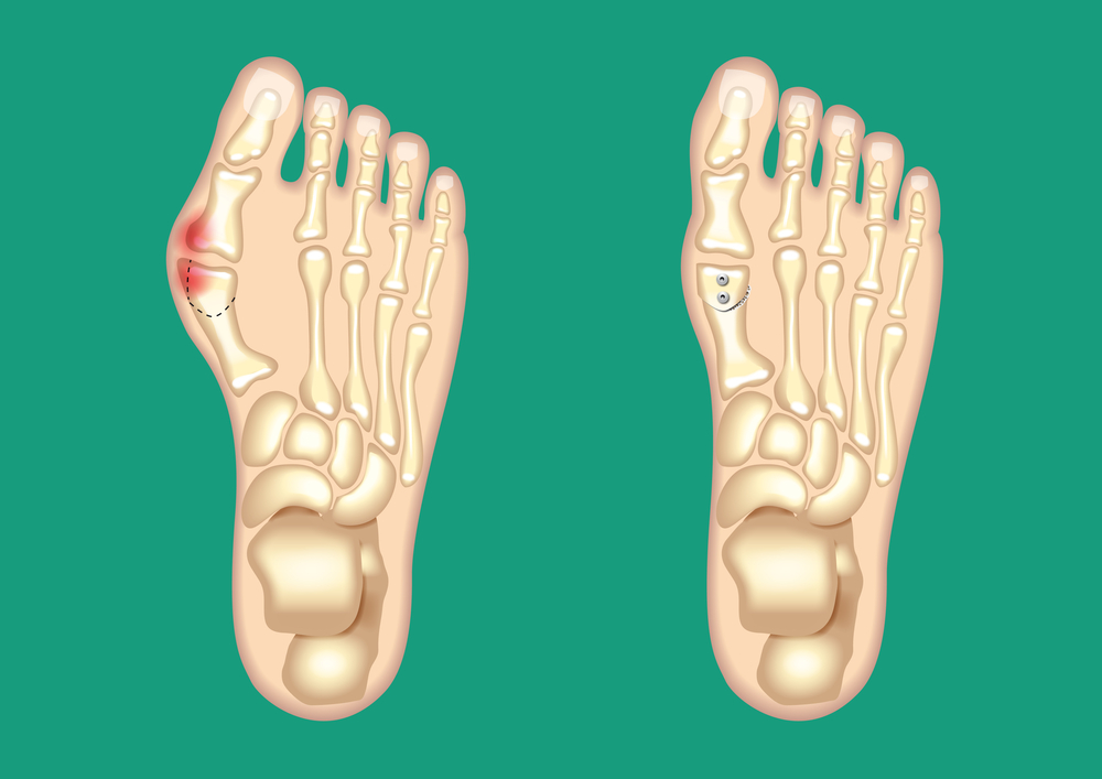 Почему болят стопы, колени и икры, и как поддержать здоровье ног – советует ортопед