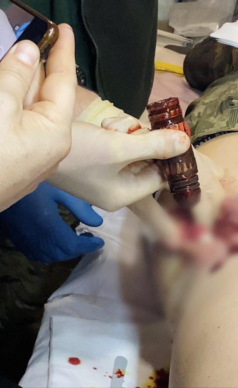 Медики дістали гранату ВОГ з тіла пораненого бійця – фото
