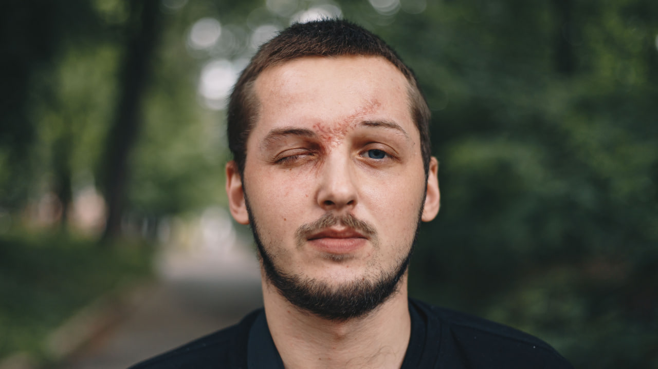 Історія Булата. Що вас чекає, якщо отримаєте поранення на війні - Фото